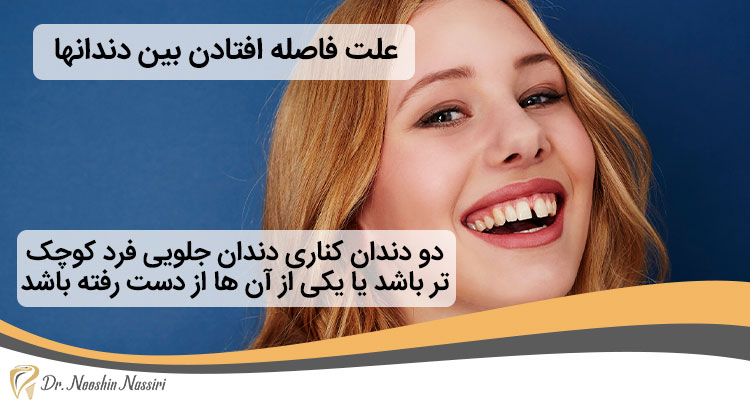 علت فاصله افتادن بین دندانها چیست