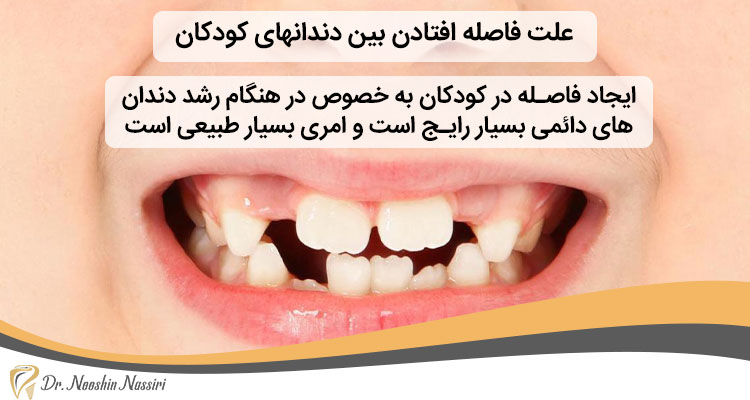 علت فاصله افتادن بین دندانهای کودکان