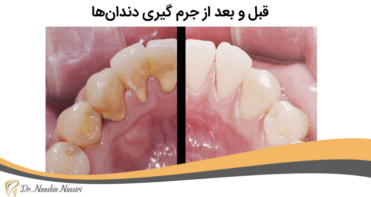 قبل و بعد از جرم گیری دندان‌ها
