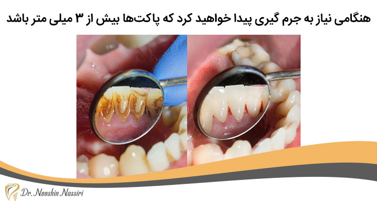 از بین بردن جرم دندان