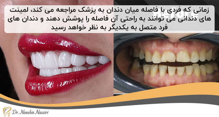 پر کردن فاصله دندان ها با لمینت دندان