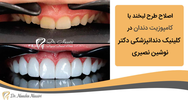 اصلاح طرح لبخند با کامپوزیت دندان