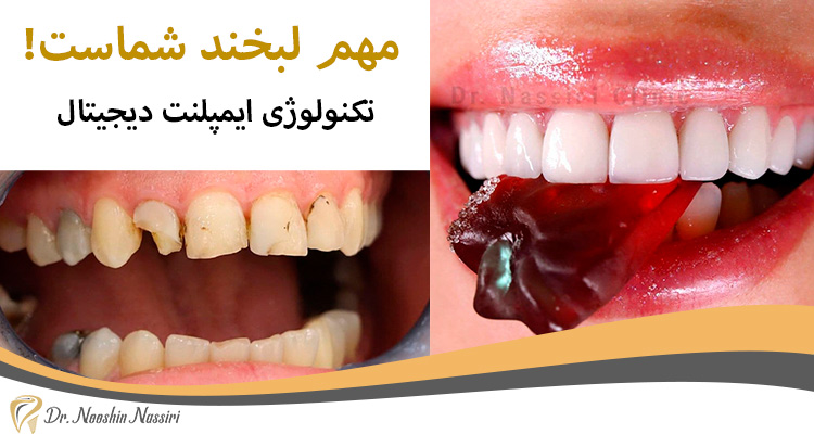 ایمپلنت دیجیتال دندان دکتر نوشین نصیری