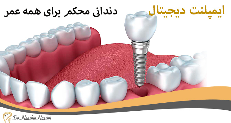 ایمپلنت دیجیتال دندانی محکم برای همه عمر
