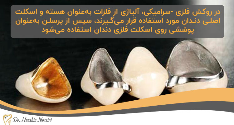روکش دندان فلزی-سرامیکی یکی از انواع روکش های دندانی