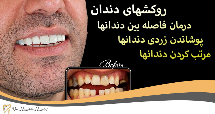 روکش دندان درمان فاصله دندانها