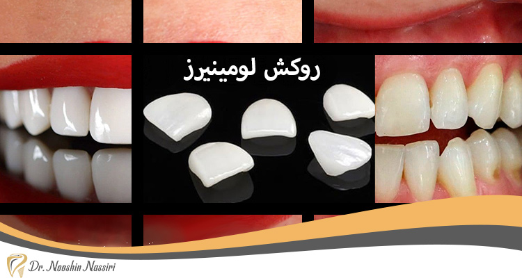 روکش لومینیرز دکتر نوشین نصیری