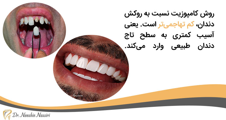 فرق کامپوزیت و روکش در آسیب به دندان