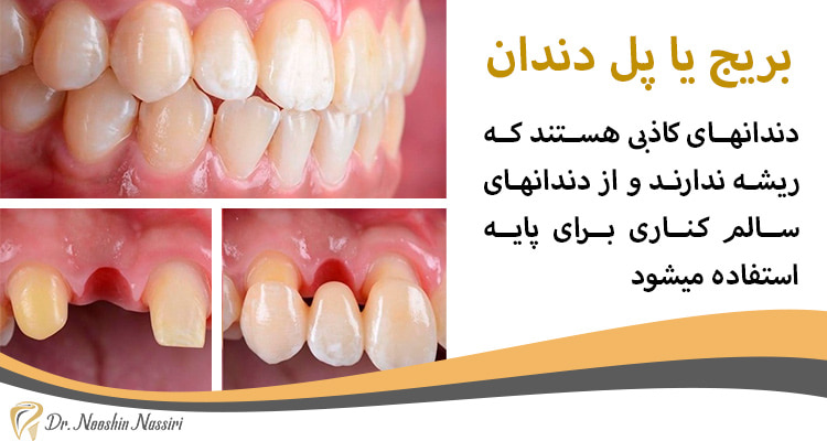 بریج یا پل دندانی دندانهای کاذب هستند