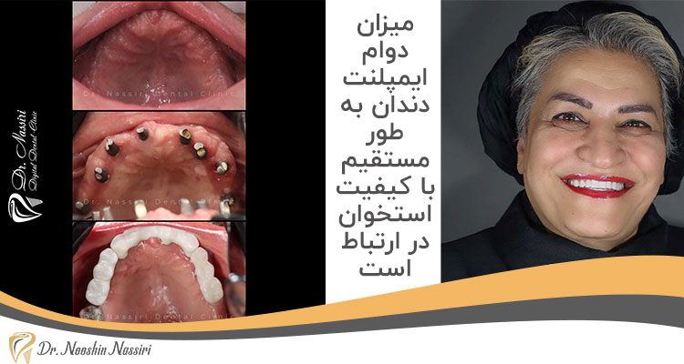 دوام ایمپلنت دندان-نمونه کار ایمپلنت دندان دکتر نوشین نصیری