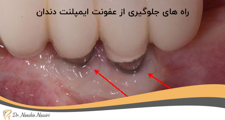 راه های جلوگیری از عفونت ایمپلنت دندان