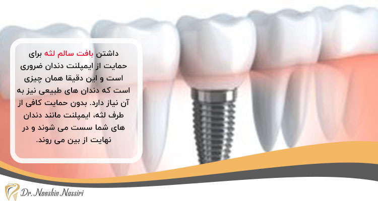 شرایط لازم برای ایمپلنت دندان روی لثه