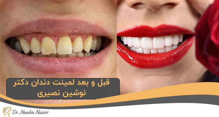 قبل و بعد لمینت دندان دکتر نوشین نصیری