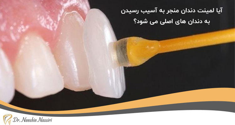 لمینت دندان منجر به آسیب رسیدن به دندان های اصلی می شود یا خیر