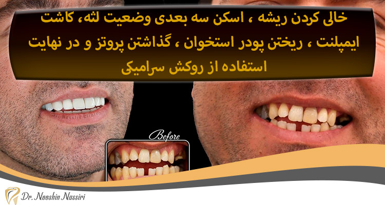 پروسه ایمپلنت دندان دکتر نصیری
