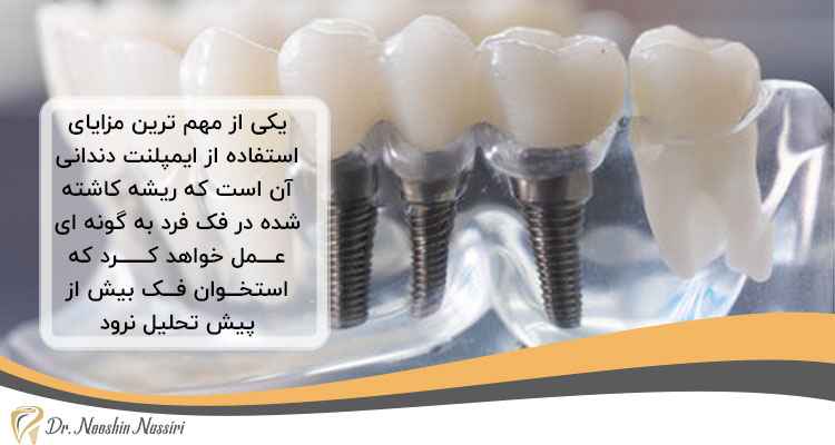مزایای ایمپلنت دندان برای سالمندان