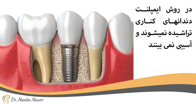 در ایمپلنت دندان دندانها تراشیده نمیشوند