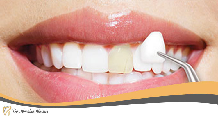لمینت دندان ها در دندان پزشکی زیبایی