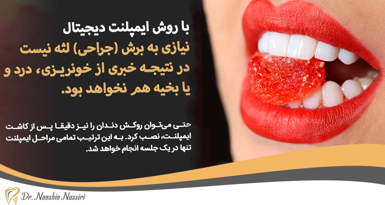گذاشتن روکش روی ایمپلنت دیجیتال دکتر نصیری