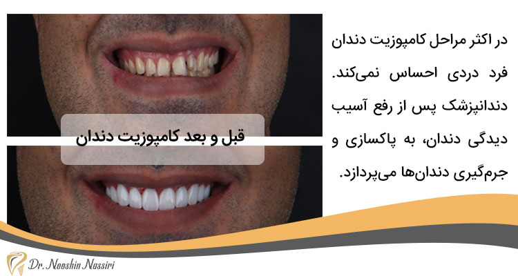 عکس قبل و بعد کامپوزیت دندان مردانه