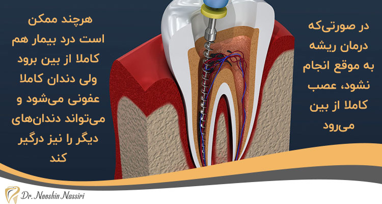 اهمیت درمان ریشه دندان