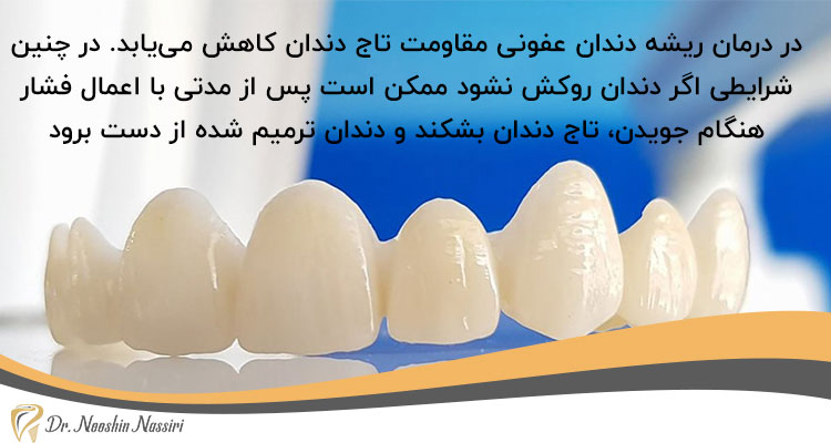 اهمیت روکش دندان بعد از درمان ریشه