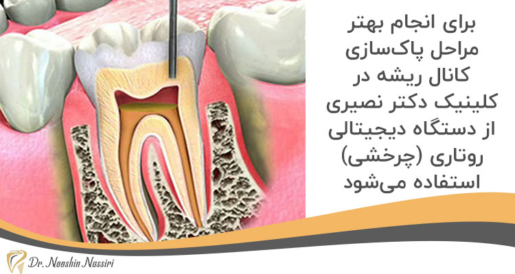 درمان ریشه با دستگاه روتاری در کلینیک دندانپزشکی دکتر نوشین نصیری