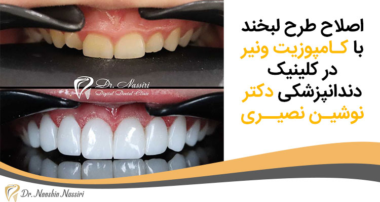 اصلاح طرح لبخند با کـامپوزیت ونیر در کلینیک دندانپزشکی دکتر نوشیـن نصیــری