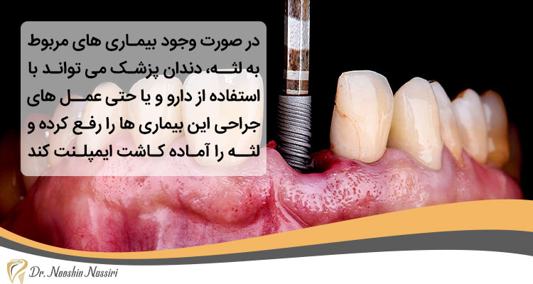 ایمپلنت دندان برای لثه آسیب دیده و بیمار