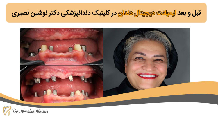 نمونه کار تصویری ایمپلنت دیجیتال دندان