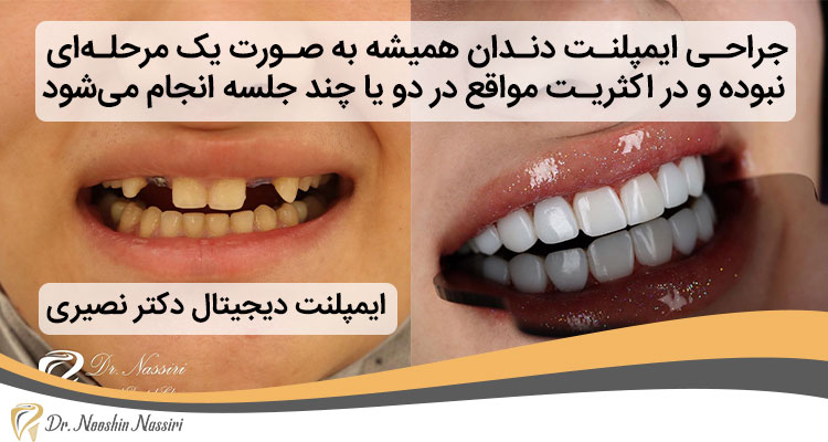 مدت زمان مراحل کاشت ایمپلنت دندان