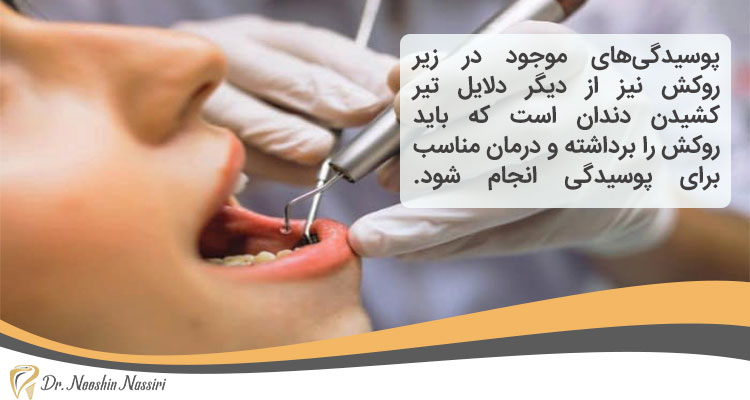 درمان تیر کشیدن دندان روکش شده