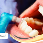 بروساژ دندان چیست