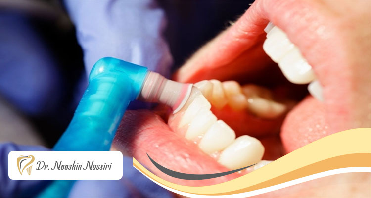 بروساژ دندان چیست