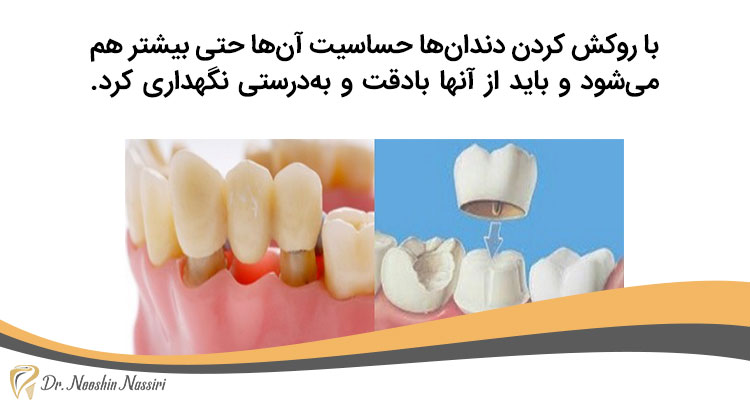 حساسیت روکش دندان