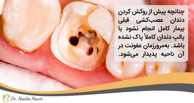 درمان ریشه ناقص دندان روکش شده