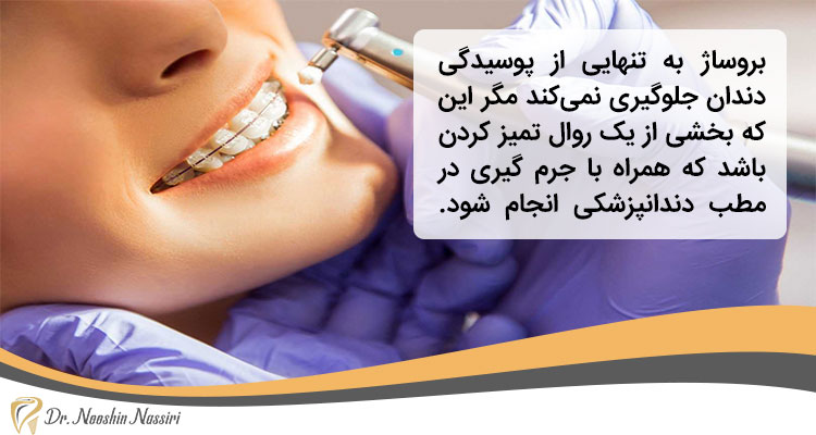 موارد احتیاط بروساژ دندان