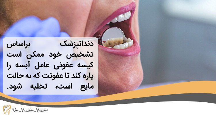 درمان عفونت دندان