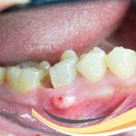 عفونت دندان چیست
