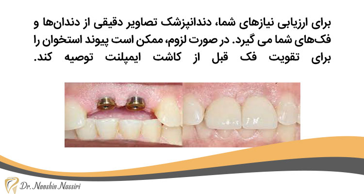پیوند استخوان قبل از ایمپلنت دندان جلو