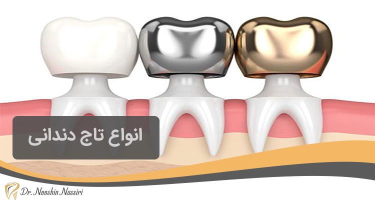 انواع تاج دندان