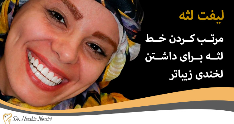 لیفت لثه