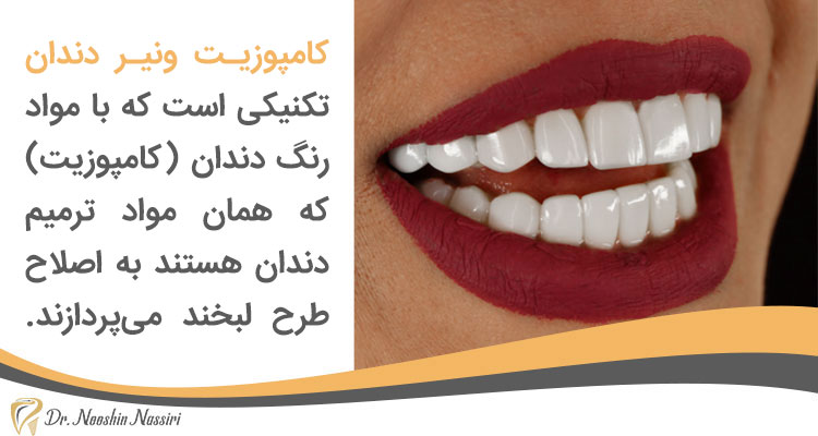 کامپوزیـت ونیـر دندان چیست