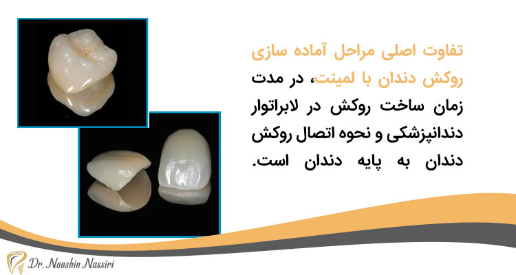 تفاوت اصلی مراحل آماده سازی روکش دندان با لمینت