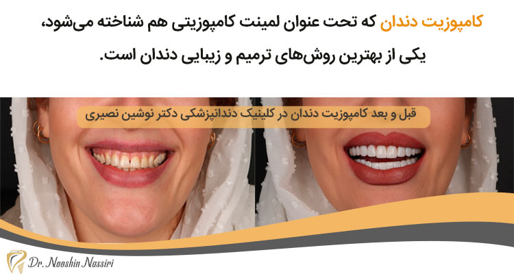 عکس قبل و بعد کامپوزیت دندان-دکتر نصیری