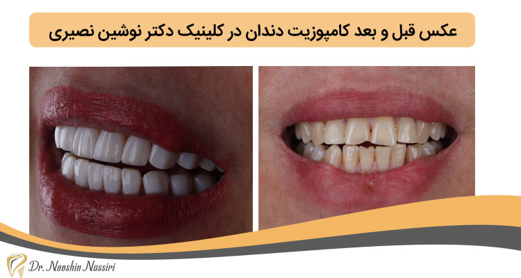عکس کامپوزیت دندان قبل و بعد