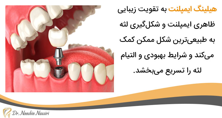 مزایای هیلینگ ایمپلنت دندان