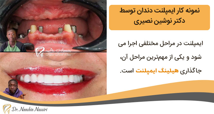 نمونه کار ایمپلنت دندان دکتر نصیری