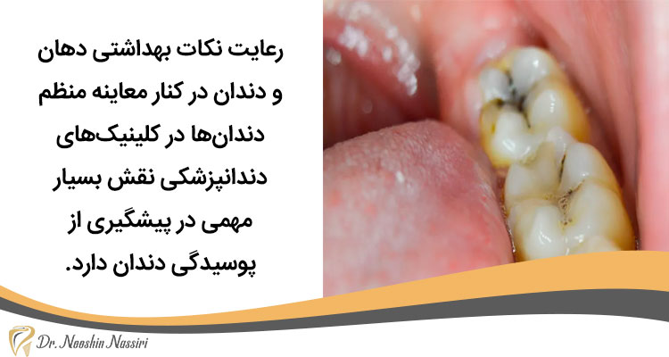 یشگیری از پوسیدگی دندان با رعایت بهداشت دهان