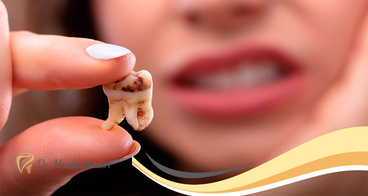 پوسیدگی دندان و روش درمان آن